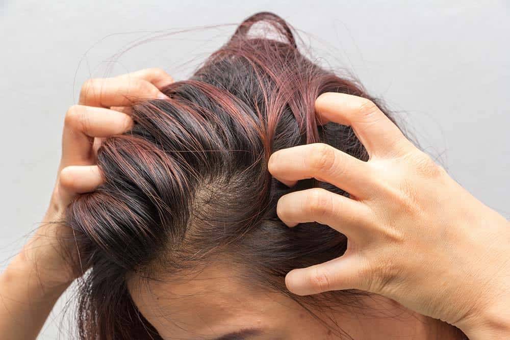 15 Home Remedies for Itchy Scalp - Hottest Haircuts